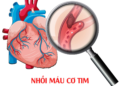 Nhồi máu cơ tim ở tuổi 23 Bệnh viện Đa khoa Khánh Hòa dấu hiệu nhồi máu cơ tim nguyên nhân nhồi máu cơ tim ở người trẻ phòng ngừa bệnh tim mạch
