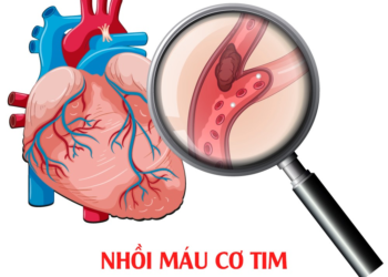 Nhồi máu cơ tim ở tuổi 23 Bệnh viện Đa khoa Khánh Hòa dấu hiệu nhồi máu cơ tim nguyên nhân nhồi máu cơ tim ở người trẻ phòng ngừa bệnh tim mạch