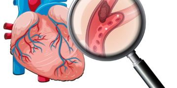 Nhồi máu cơ tim ở tuổi 23 Bệnh viện Đa khoa Khánh Hòa dấu hiệu nhồi máu cơ tim nguyên nhân nhồi máu cơ tim ở người trẻ phòng ngừa bệnh tim mạch