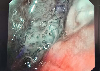 Cẩn trọng với ù tai kéo dài: Có thể là dấu hiệu cảnh báo ung thư vòm mũi họng