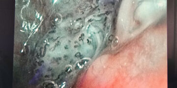 Cẩn trọng với ù tai kéo dài: Có thể là dấu hiệu cảnh báo ung thư vòm mũi họng