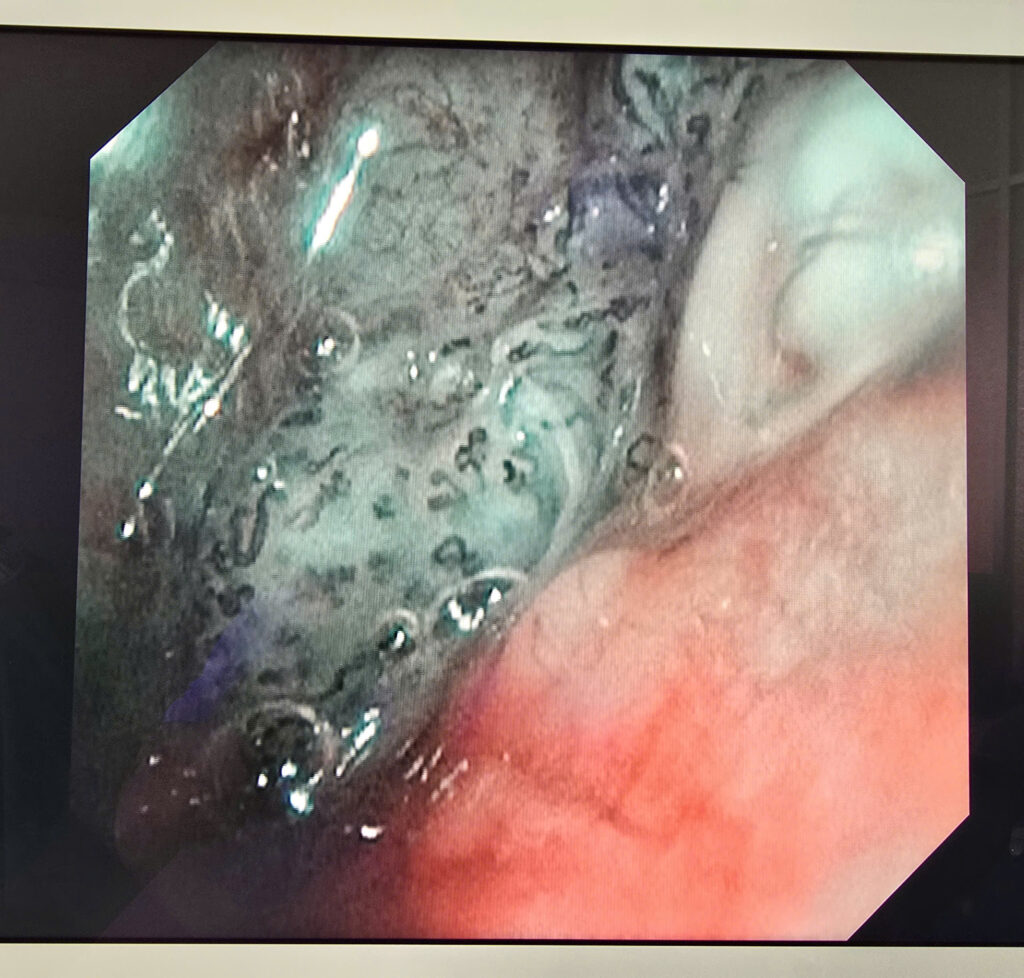 Ung thư vòm mũi họng Tầm soát ung thư Ù tai kéo dài Nội soi NBI Bệnh viện Đa khoa Khánh Hòa Triệu chứng ung thư vòm họng