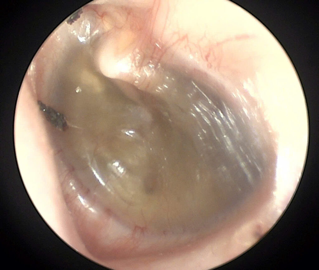 Ung thư vòm mũi họng Tầm soát ung thư Ù tai kéo dài Nội soi NBI Bệnh viện Đa khoa Khánh Hòa Triệu chứng ung thư vòm họng