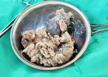 Hội chứng Rapunzel thói quen ăn tóc ở trẻ rối loạn Pica dị vật dạ dày ở trẻ em Bệnh viện Đa khoa Khánh Hòa