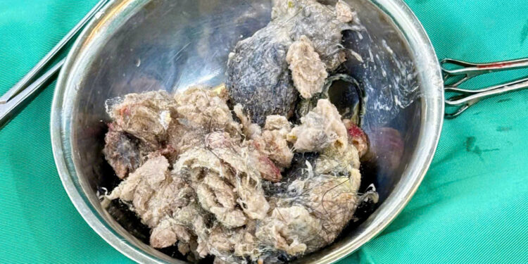 Hội chứng Rapunzel thói quen ăn tóc ở trẻ rối loạn Pica dị vật dạ dày ở trẻ em Bệnh viện Đa khoa Khánh Hòa