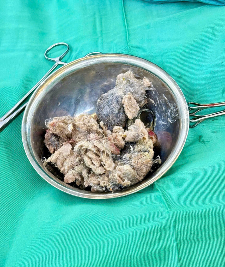 Hội chứng Rapunzel thói quen ăn tóc ở trẻ rối loạn Pica dị vật dạ dày ở trẻ em Bệnh viện Đa khoa Khánh Hòa