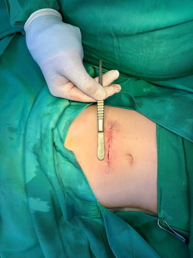 Hội chứng Rapunzel thói quen ăn tóc ở trẻ rối loạn Pica dị vật dạ dày ở trẻ em Bệnh viện Đa khoa Khánh Hòa