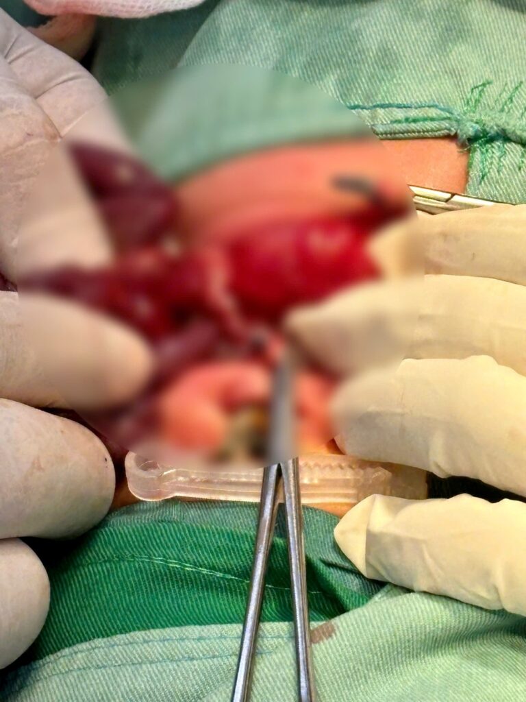 sơ sinh xoắn ruột xoắn ruột do ruột xoay bất toàn cấp cứu ngoại nhi sơ sinh nôn dịch xanh trẻ sơ sinh dấu hiệu whirlpool siêu âm
