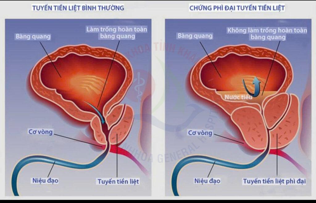 Tăng sinh tiền liệt tuyến u xơ tuyến tiền liệt tuyến tiền liệt tiểu đêm ở nam giới khám tiết niệu Khánh Hòa