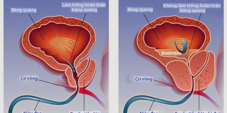 Tăng sinh tiền liệt tuyến u xơ tuyến tiền liệt tuyến tiền liệt tiểu đêm ở nam giới khám tiết niệu Khánh Hòa
