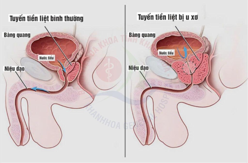Tăng sinh tiền liệt tuyến u xơ tuyến tiền liệt tuyến tiền liệt tiểu đêm ở nam giới khám tiết niệu Khánh Hòa