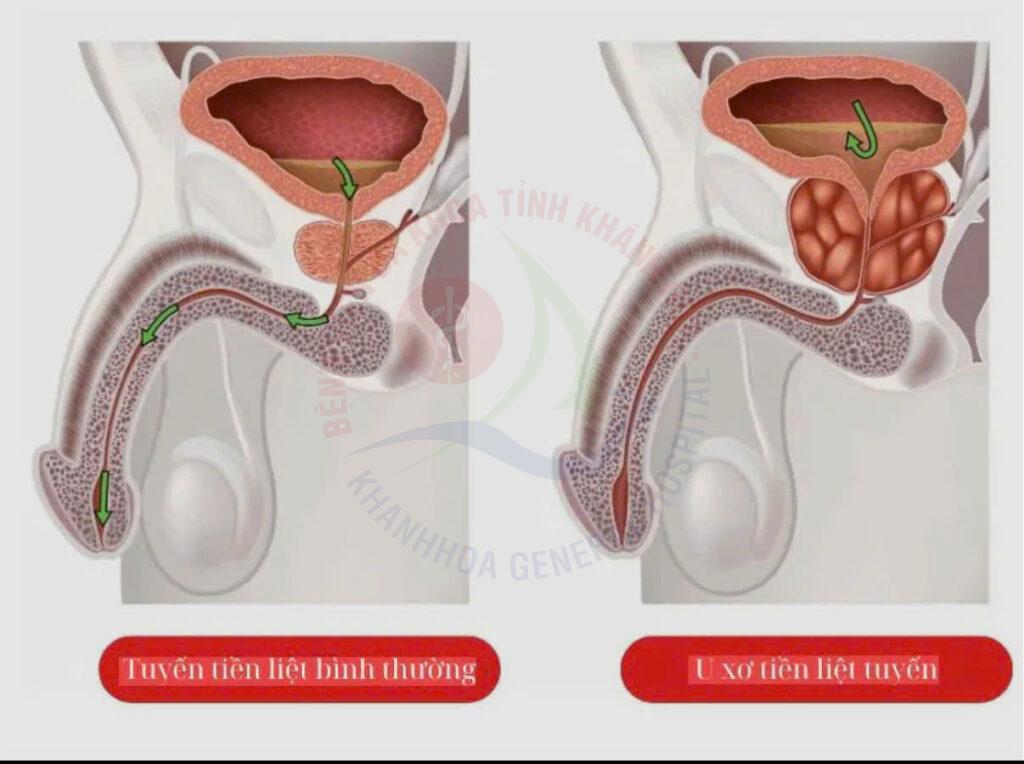 Tăng sinh tiền liệt tuyến u xơ tuyến tiền liệt tuyến tiền liệt tiểu đêm ở nam giới khám tiết niệu Khánh Hòa