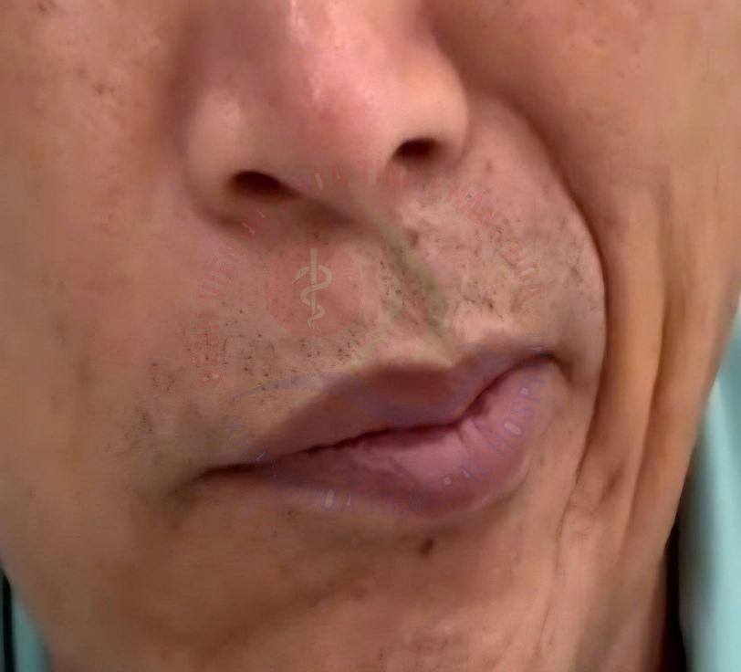 Co giật nửa mặt Phẫu thuật giải ép vi mạch dây thần kinh số VII điều trị co giật nửa mặt Khoa Ngoại Thần kinh Bệnh viện Đa khoa Khánh Hòa