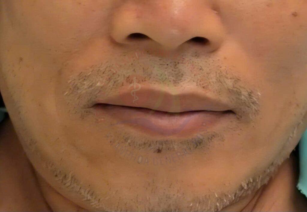 Co giật nửa mặt Phẫu thuật giải ép vi mạch dây thần kinh số VII điều trị co giật nửa mặt Khoa Ngoại Thần kinh Bệnh viện Đa khoa Khánh Hòa