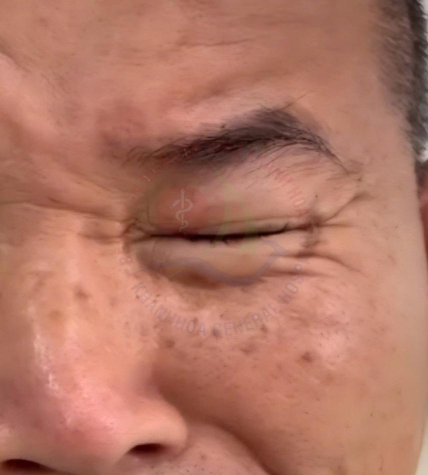 Co giật nửa mặt Phẫu thuật giải ép vi mạch dây thần kinh số VII điều trị co giật nửa mặt Khoa Ngoại Thần kinh Bệnh viện Đa khoa Khánh Hòa