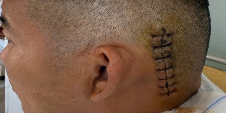 Co giật nửa mặt Phẫu thuật giải ép vi mạch dây thần kinh số VII điều trị co giật nửa mặt Khoa Ngoại Thần kinh Bệnh viện Đa khoa Khánh Hòa