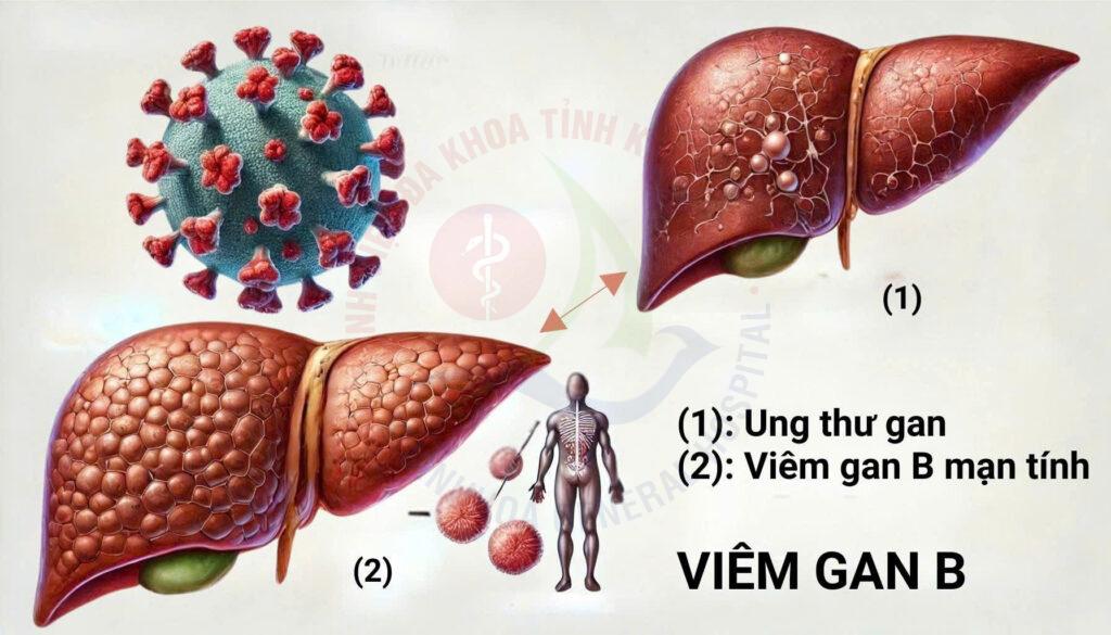 Viêm gan B Viêm gan B lây qua đâu xét nghiệm viêm gan B tiêm vắc xin viêm gan B phòng ngừa viêm gan B Bệnh viện Đa khoa Khánh Hòa