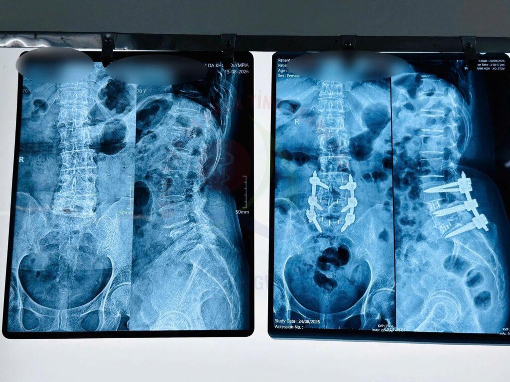 Phẫu thuật cột sống Trượt đốt sống thắt lưng thoát vị đĩa đệm phẫu thuật ít xâm lấn Khoa Ngoại Cột sống BVĐK Khánh Hòa Việt kiều chữa bệnh