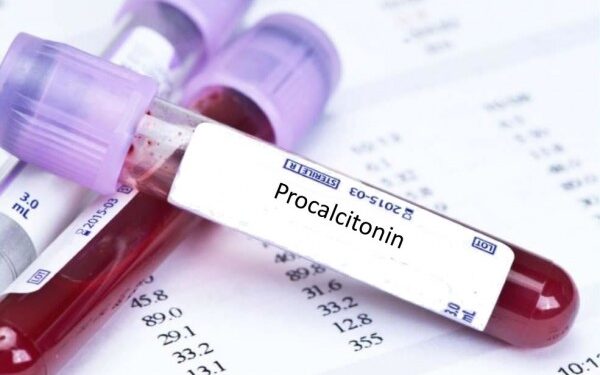 Xét nghiệm Procalcitonin Xét nghiệm PCT nhiễm trùng huyết BVĐK Khánh Hòa chẩn đoán nhiễm khuẩn