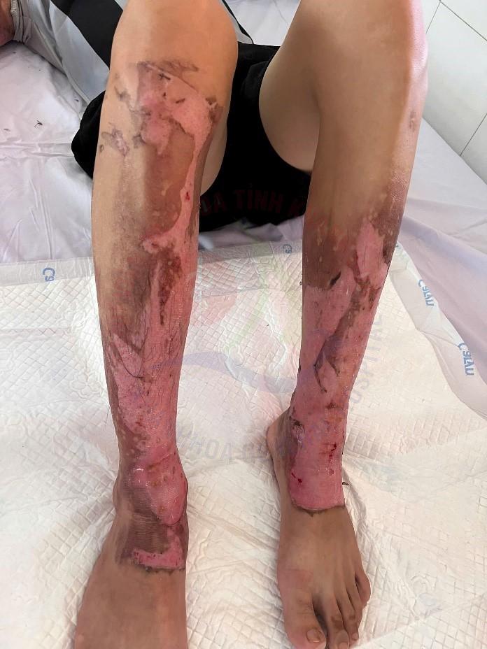 phòng chống bỏng sơ cứu bỏng nguyên nhân gây bỏng cách xử lý khi bị bỏng điều trị bỏng ở đâu trung tâm chấn thương chỉnh hình bỏng khánh hòa