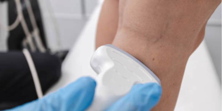 suy van tĩnh mạch chi dưới suy giãn tĩnh mạch chân siêu âm Doppler tĩnh mạch triệu chứng suy tĩnh mạch điều trị suy tĩnh mạch chi dưới Bệnh viện Đa khoa Khánh Hòa